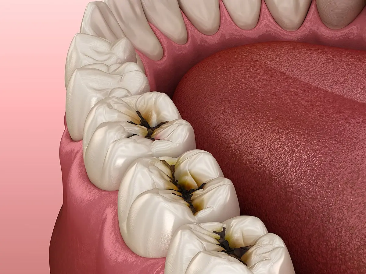 Эта безобидная привычка сводит на нет всю вашу борьбу с кариесом. Узнайте, какая!