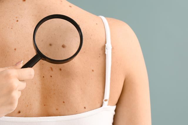 Родинки под прицелом солнца: знаки судьбы или скрытая угроза?